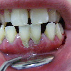 Periodontoloji (Diş Eti Tedavisi)
