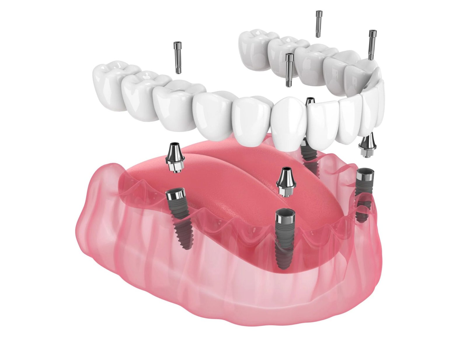 All on 4 Turkey implant diagram showing implant screws, abutments, and fixed prosthesis in a 3D exploded view