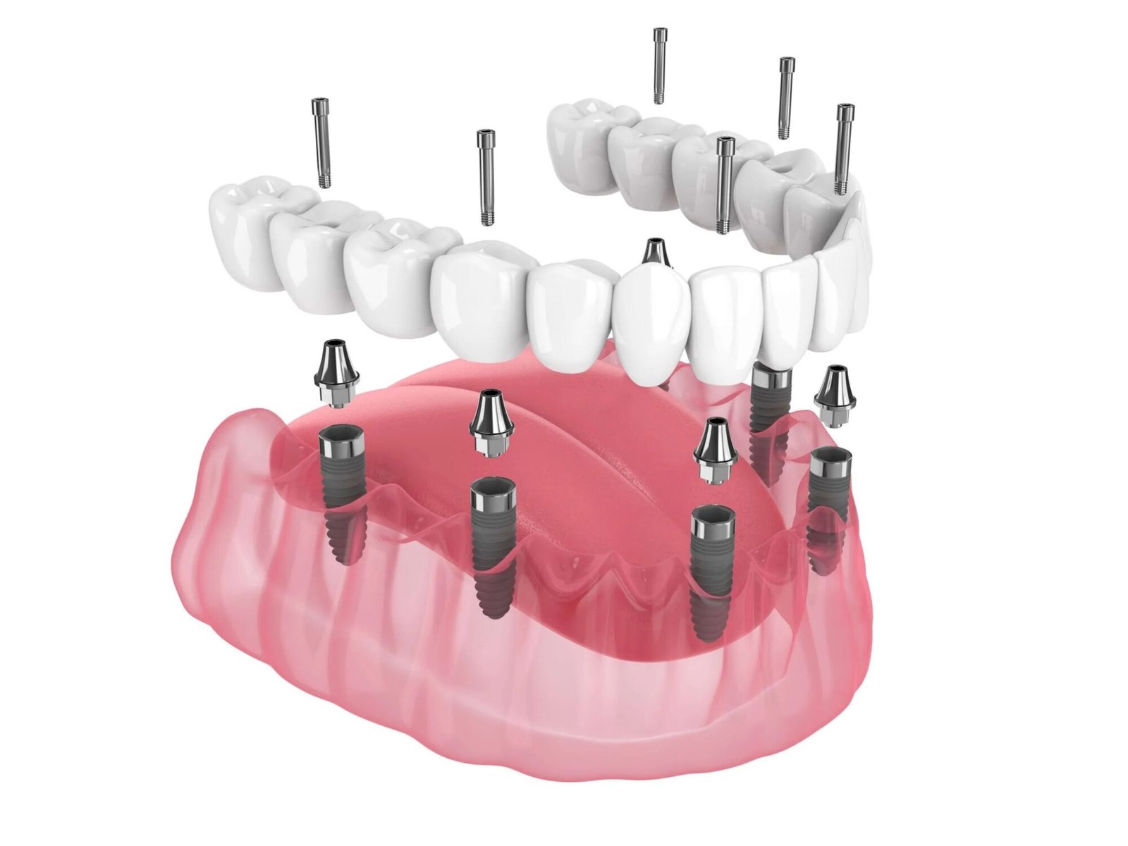 Exploded 3D diagram of All on 6 Turkey dental implants in lower jaw