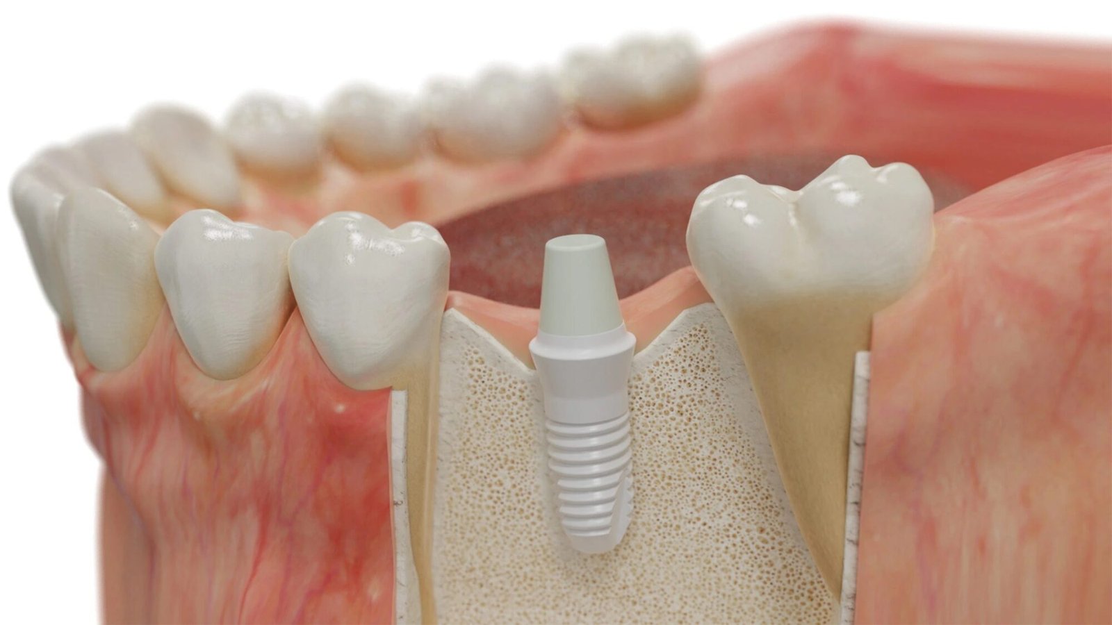 Cross-section showing ceramic dental implant placed in the jawbone – ceramic implants turkey