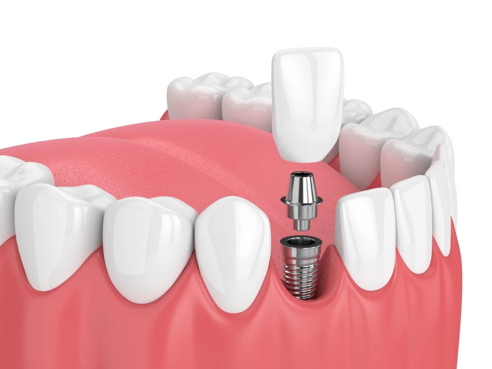 Dental implant structure visualized for single tooth replacement – Dental Implants Turkey