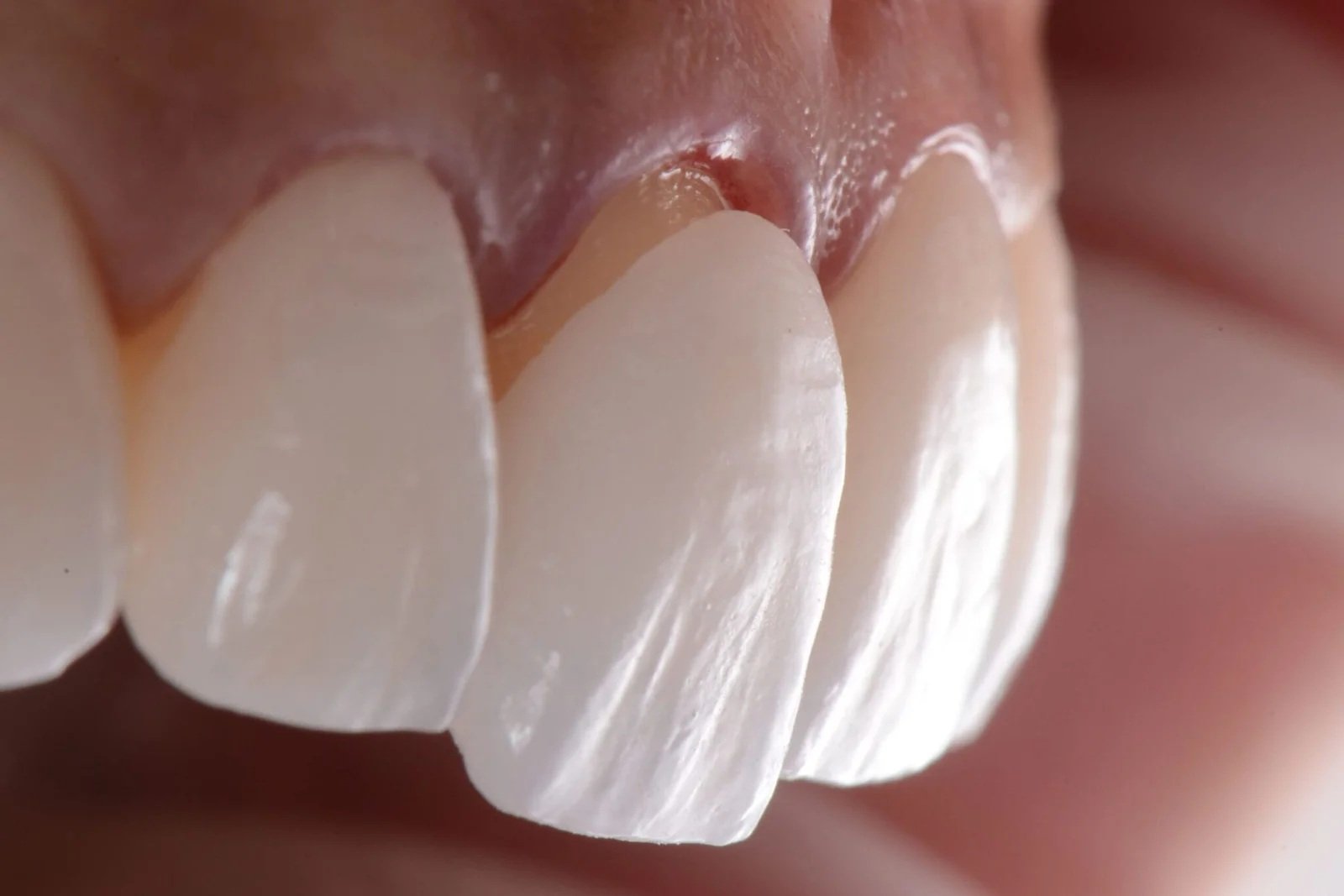 Close-up of laminate veneers applied to front teeth – Laminate Veneers Turkey