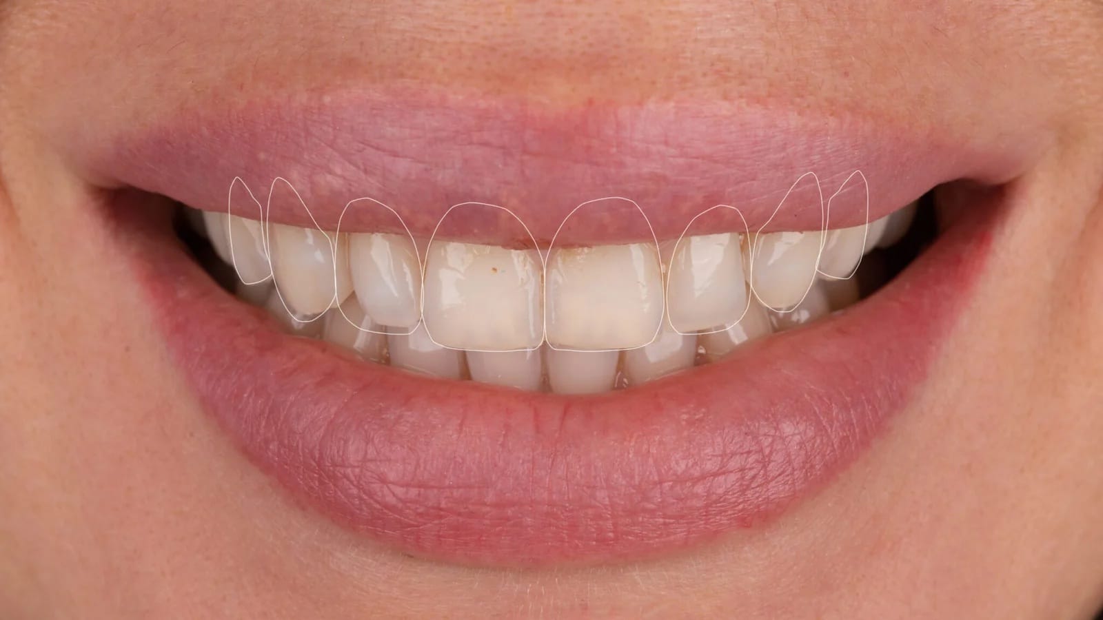 Close-up of smile with digital tooth shape outlines – smile makeover turkey