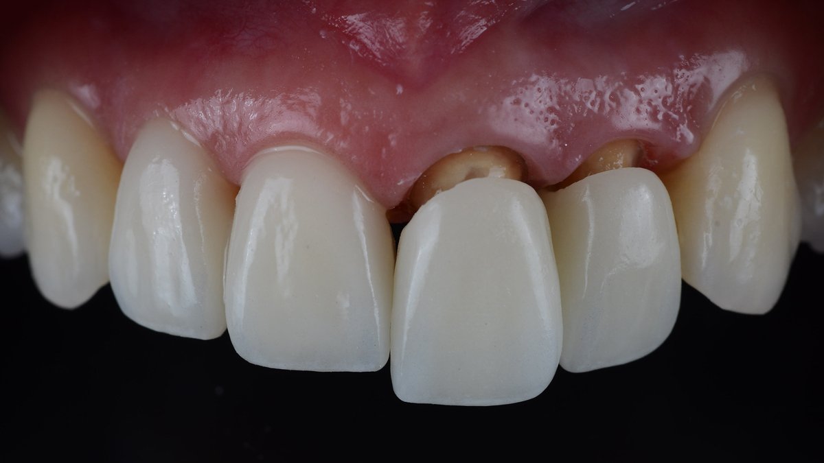 Close-up of zirconium crowns applied on upper front teeth – Zirconium Crowns Turkey
