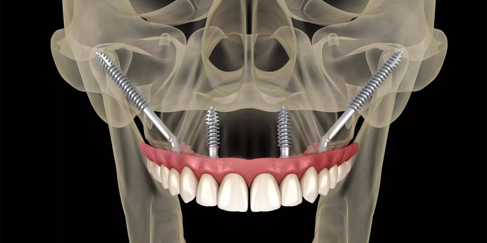 3D X-ray illustration of zygoma implants turkey anchored in cheekbone to support upper jaw fixed teeth
