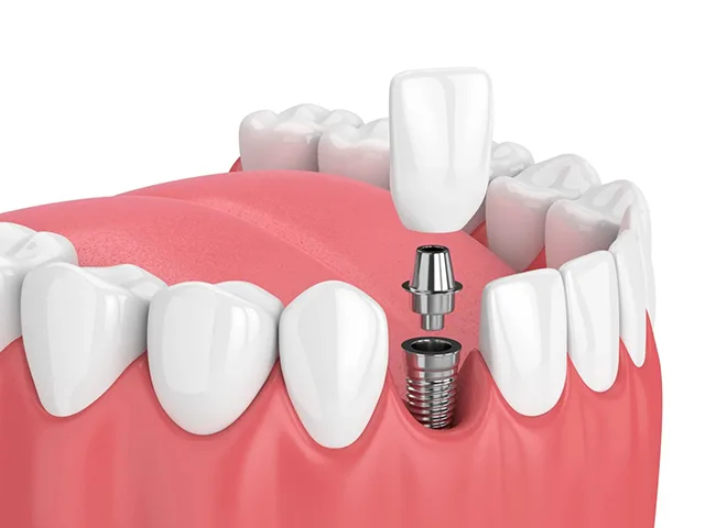 Cross-sectional illustration of a dental implant with abutment and crown inside the gum tissue